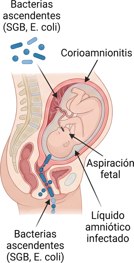 Corte sagital de embarazo con bacterias ascendentes (SGB, E. coli) desde el canal del parto, corioamnionitis, aspiración fetal y líquido amniótico infectado